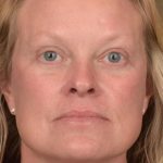Facelift Before & After Patient #2872