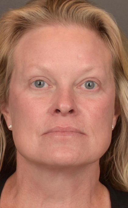 Facelift Before & After Patient #2872