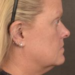 Facelift Before & After Patient #2872
