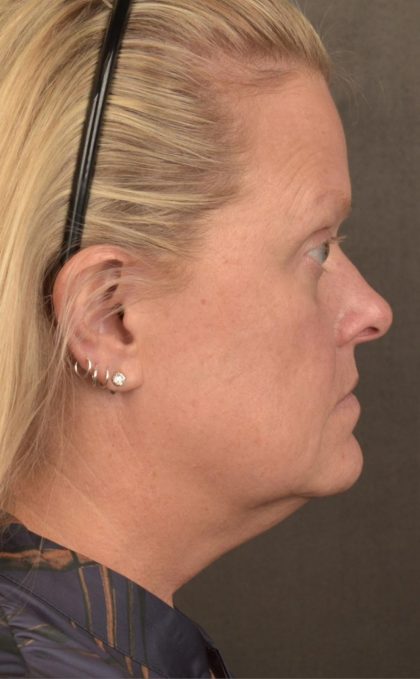 Facelift Before & After Patient #2872