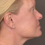 Facelift Before & After Patient #2872