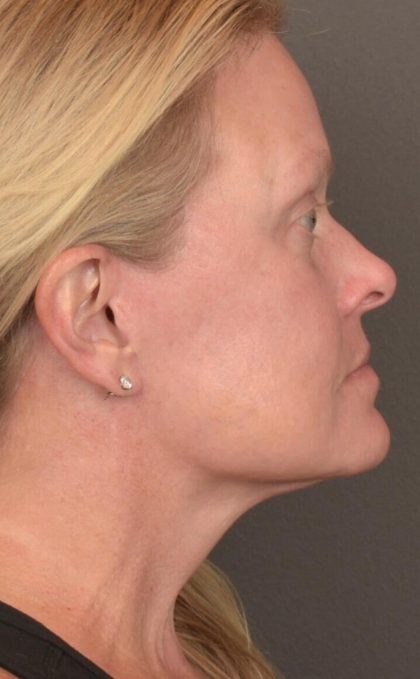 Facelift Before & After Patient #2872