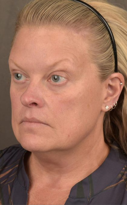 Facelift Before & After Patient #2872