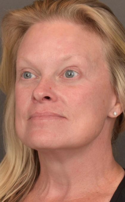 Facelift Before & After Patient #2872