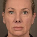 Facelift Before & After Patient #2873