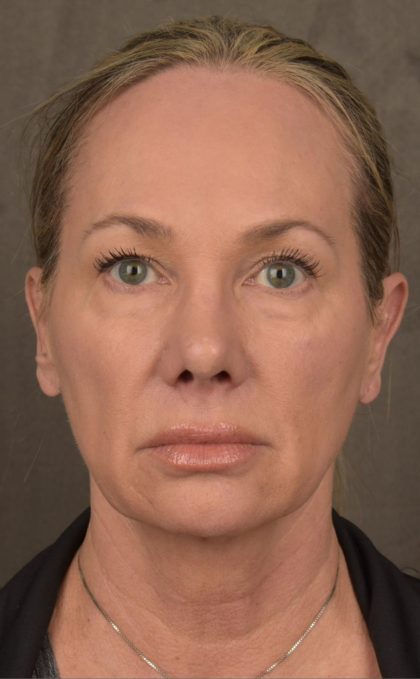 Facelift Before & After Patient #2873