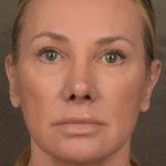 Facelift Before & After Patient #2873