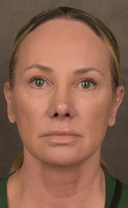 Facelift Before & After Patient #2873