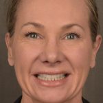Facelift Before & After Patient #2873