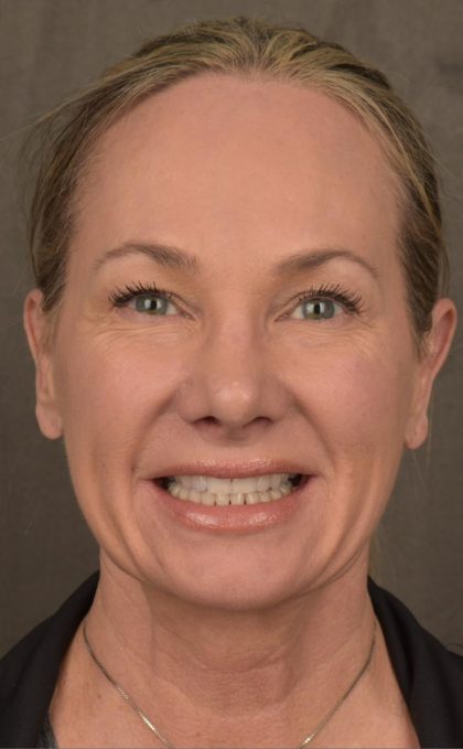 Facelift Before & After Patient #2873