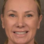 Facelift Before & After Patient #2873