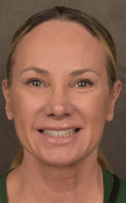 Facelift Before & After Patient #2873