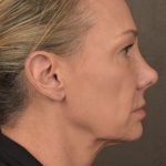 Facelift Before & After Patient #2873