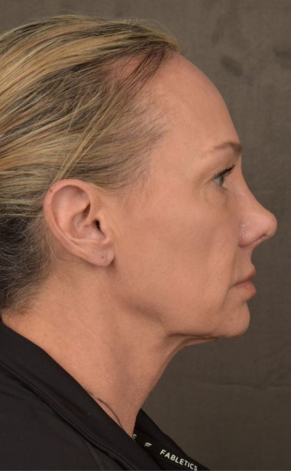 Facelift Before & After Patient #2873