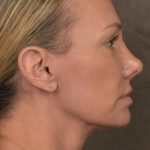 Facelift Before & After Patient #2873