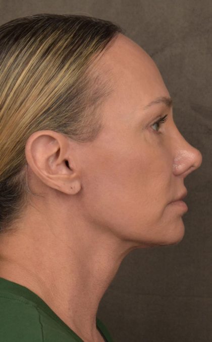 Facelift Before & After Patient #2873
