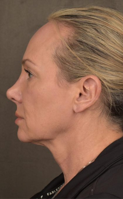 Facelift Before & After Patient #2873