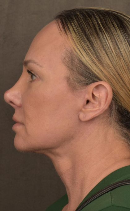 Facelift Before & After Patient #2873