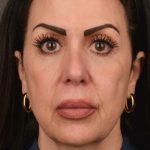 Facelift Before & After Patient #2874