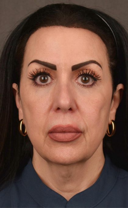 Facelift Before & After Patient #2874