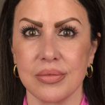 Facelift Before & After Patient #2874