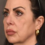Facelift Before & After Patient #2874