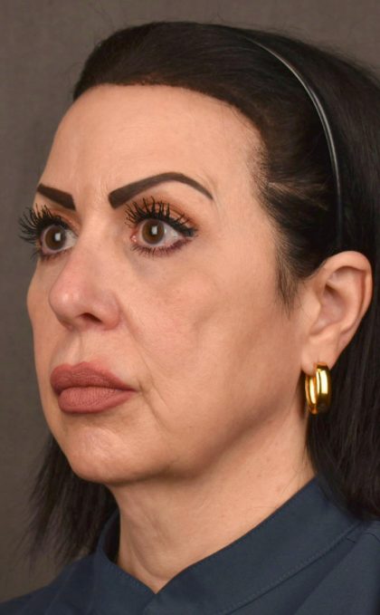Facelift Before & After Patient #2874