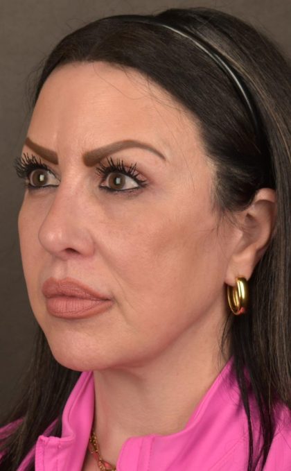 Facelift Before & After Patient #2874