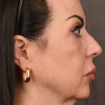 Facelift Before & After Patient #2874