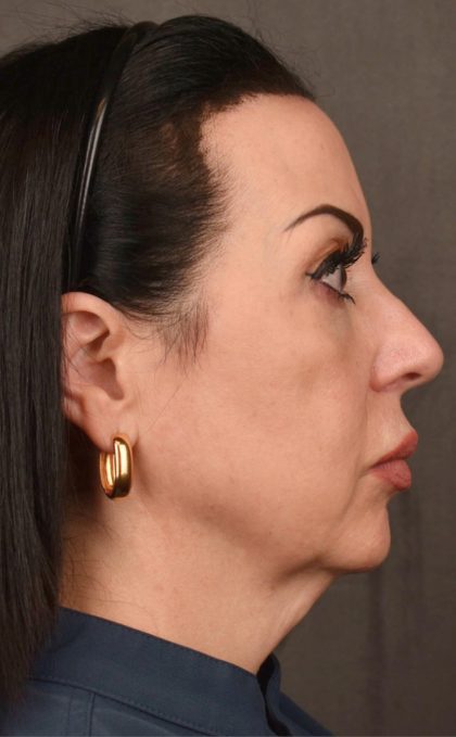 Facelift Before & After Patient #2874
