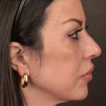 Facelift Before & After Patient #2874