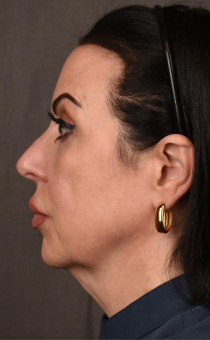 Facelift Before & After Patient #2874