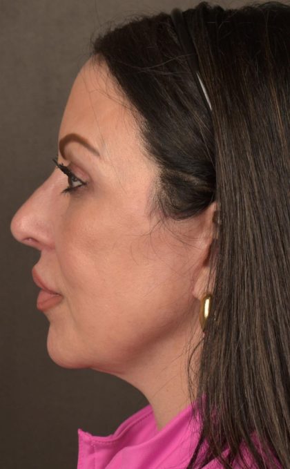 Facelift Before & After Patient #2874