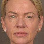 Facelift Before & After Patient #2875