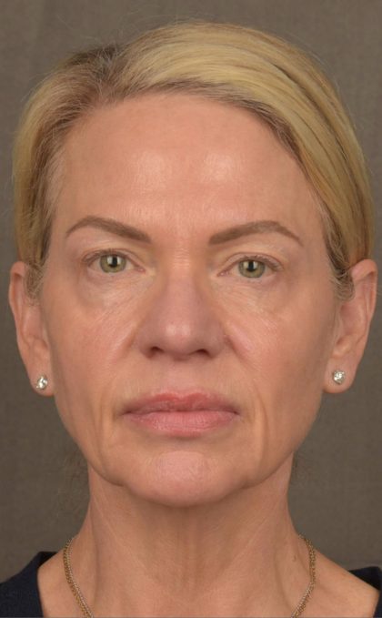 Facelift Before & After Patient #2875