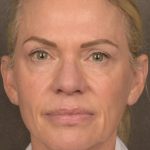 Facelift Before & After Patient #2875