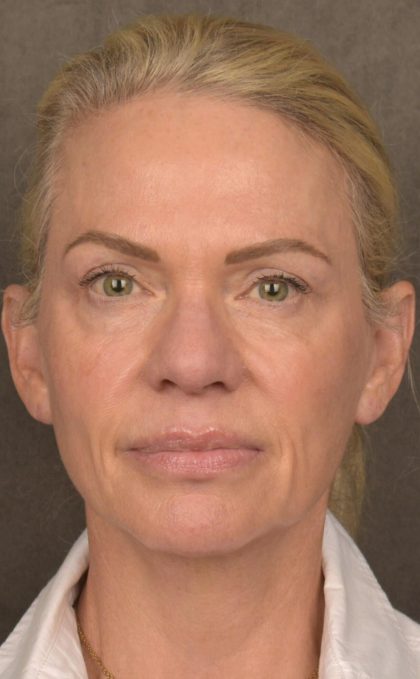 Facelift Before & After Patient #2875