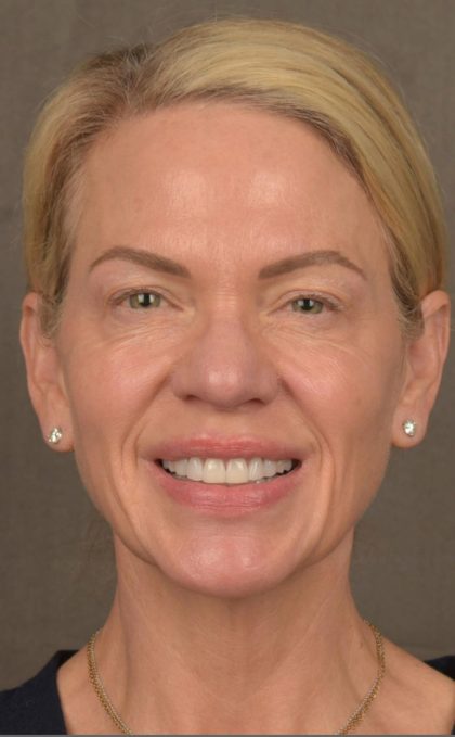Facelift Before & After Patient #2875