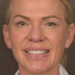 Facelift Before & After Patient #2875