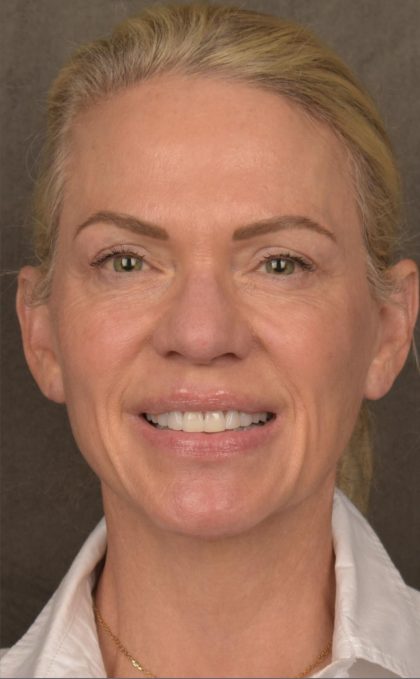 Facelift Before & After Patient #2875
