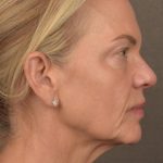 Facelift Before & After Patient #2875