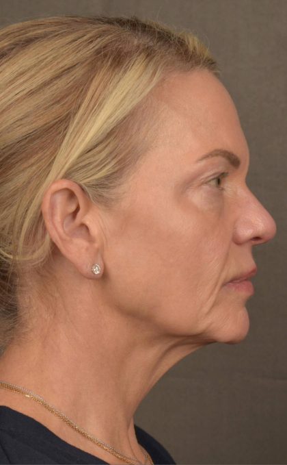 Facelift Before & After Patient #2875