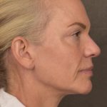 Facelift Before & After Patient #2875