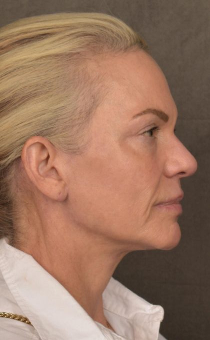 Facelift Before & After Patient #2875