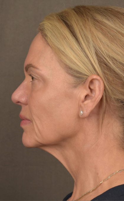 Facelift Before & After Patient #2875
