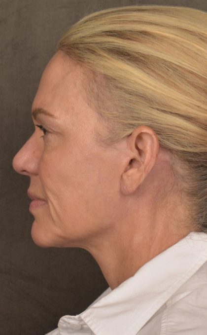 Facelift Before & After Patient #2875