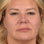 Facelift Before & After Patient #2876