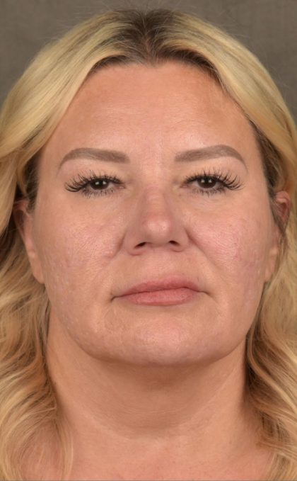 Facelift Before & After Patient #2876