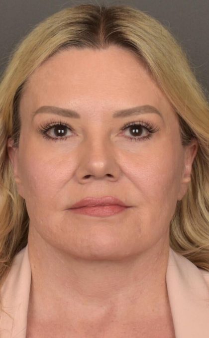 Facelift Before & After Patient #2876