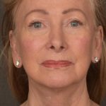 Facelift Before & After Patient #2867